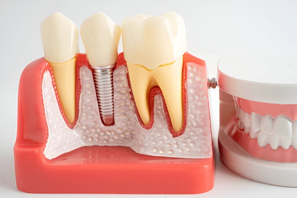 dental-implant-model