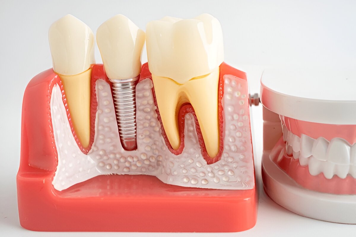 Dental Implant in Norristown