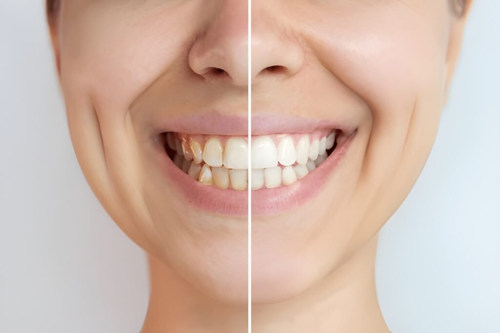 Patient receiving safe and effective teeth whitening treatment at Amor Dental Arts in Norristown, PA.