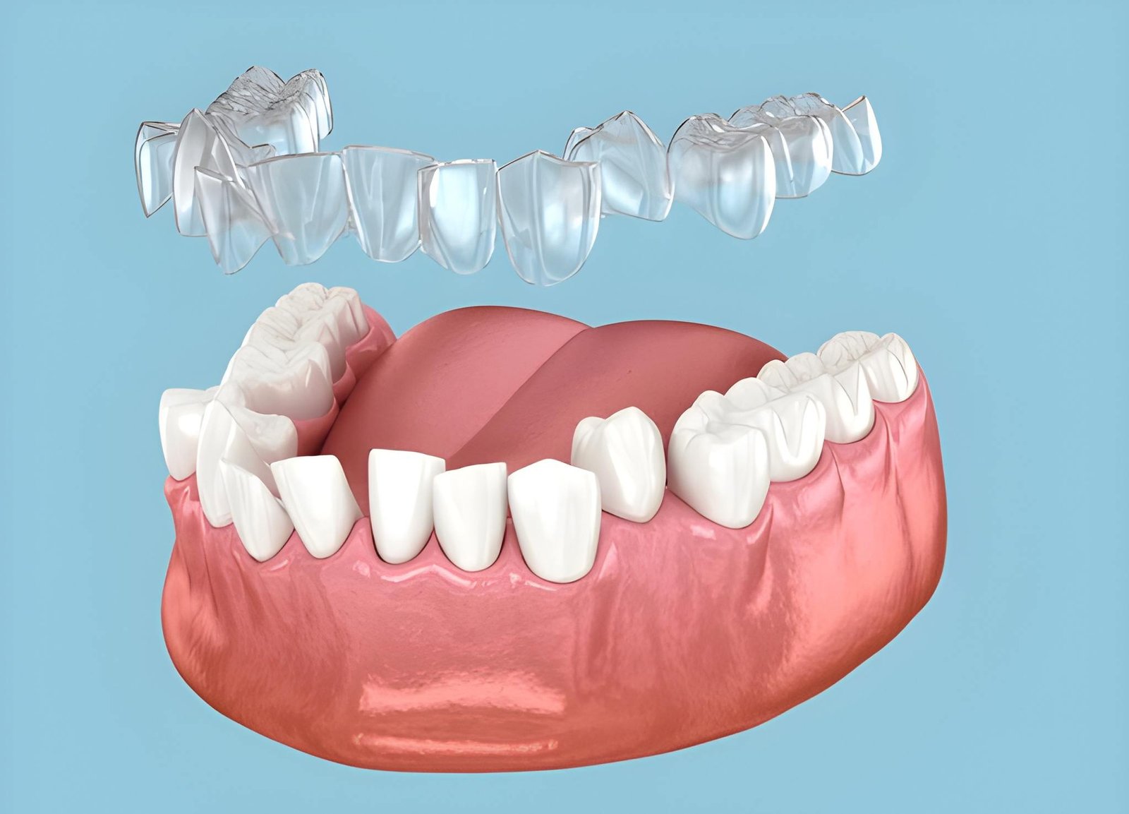 3D illustration of Invisalign clear aligners over teeth.