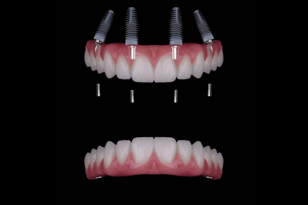 All on X dental implants