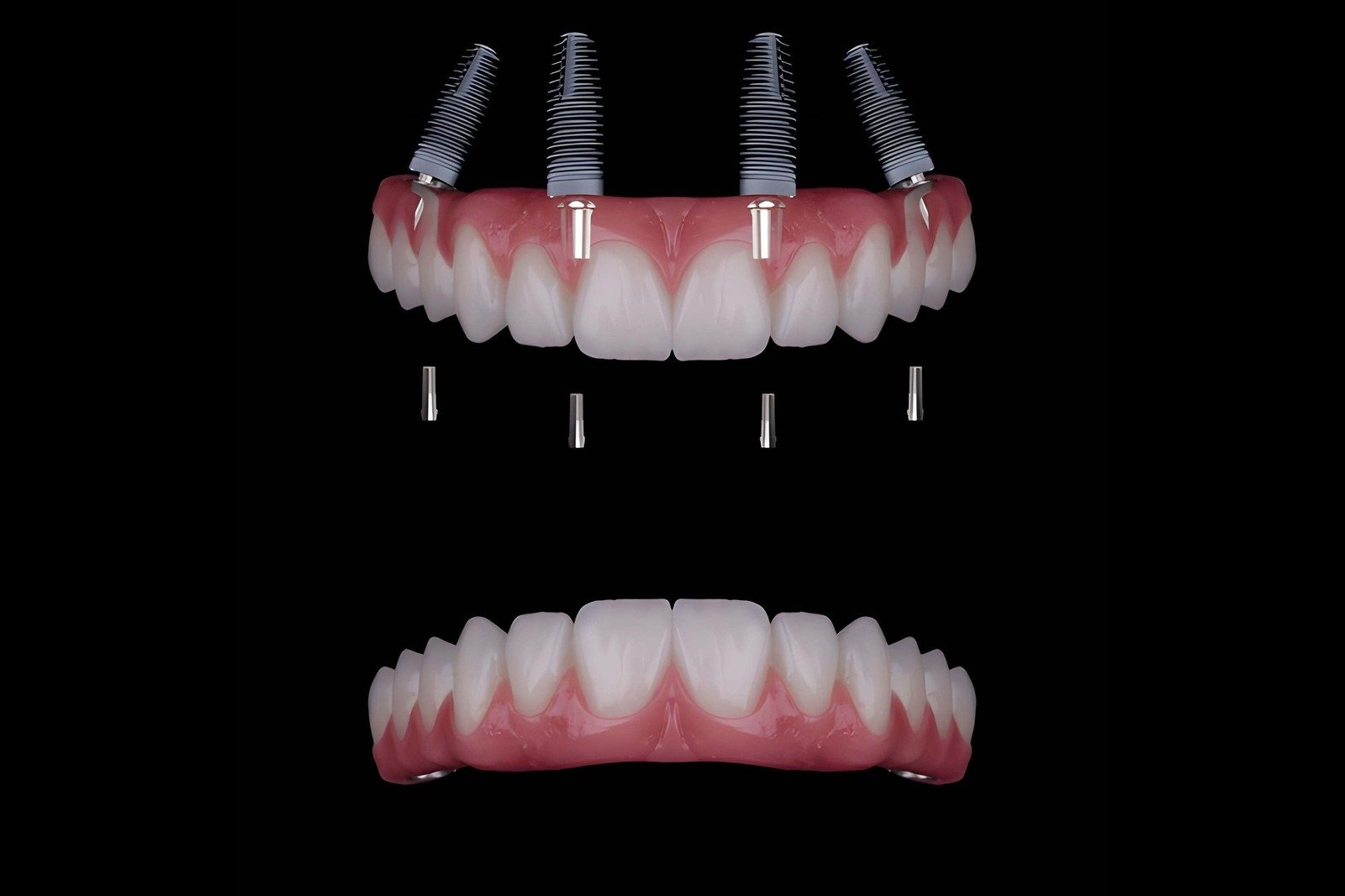 All on X dental implants