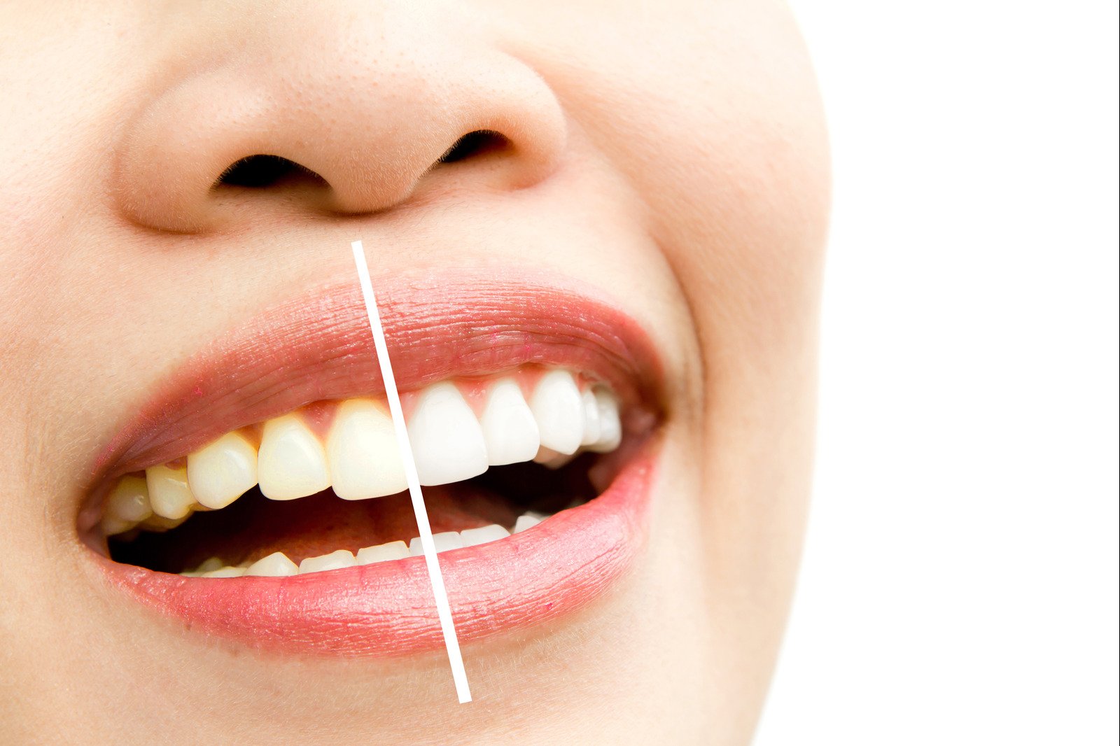 Teeth whitening treatment